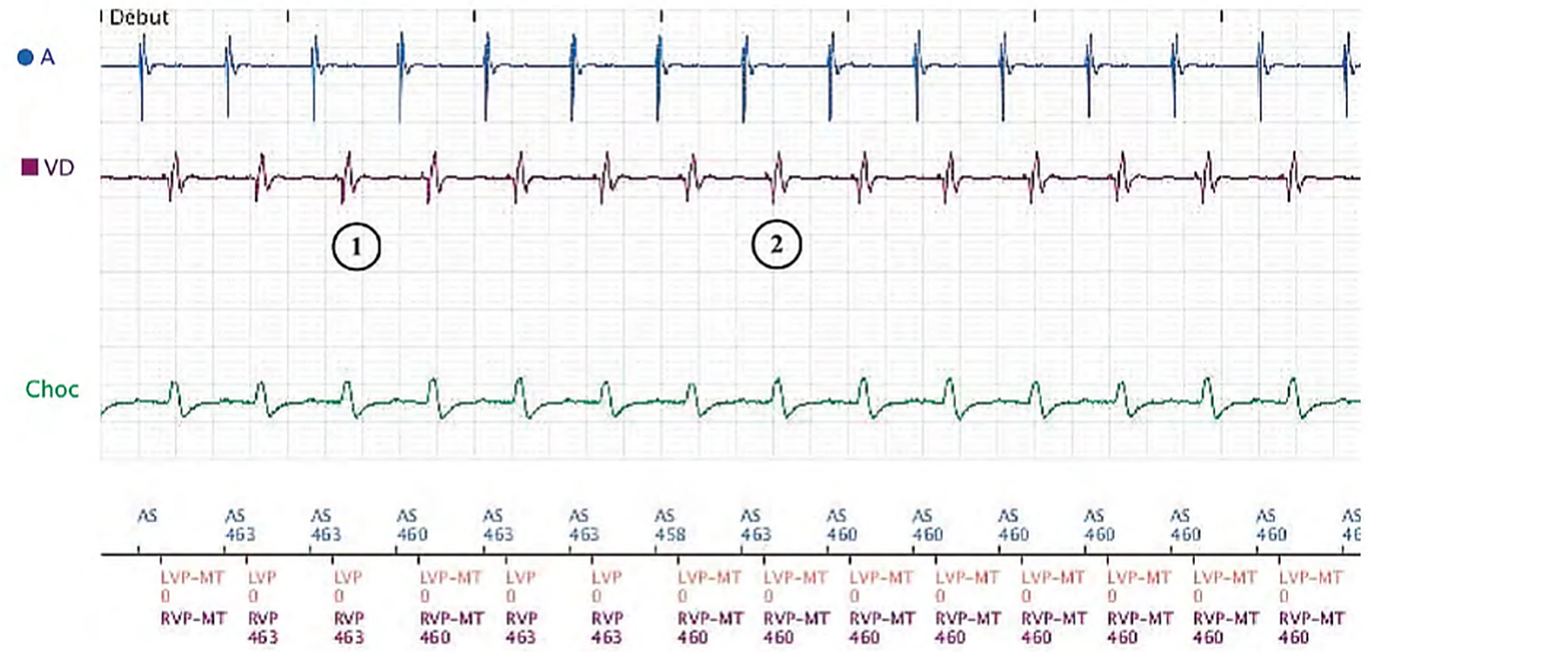 Électrogramme Boston Scientific CRT, segment 1/3 — Effort, algorithme anti-TRE et détection VG