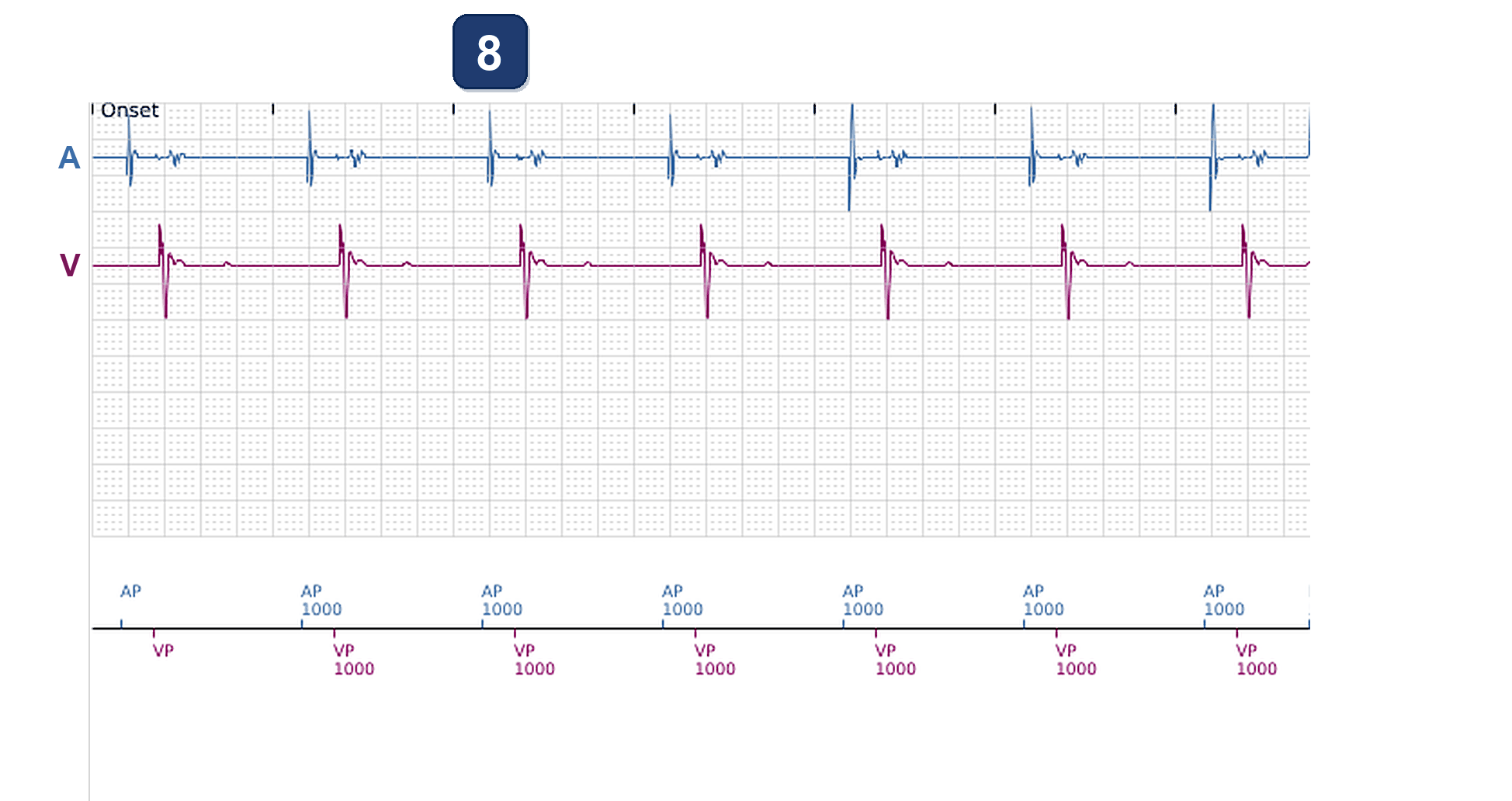 Électrogramme Boston Scientific CRT, segment 11/13 — CRT avec un stimulateur double chambre par LBBAP