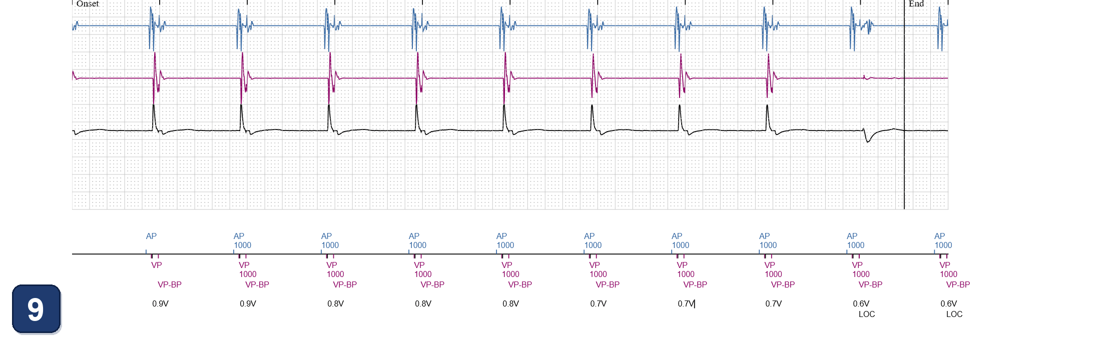 Électrogramme Boston Scientific CRT, segment 12/13 — CRT avec un stimulateur double chambre par LBBAP