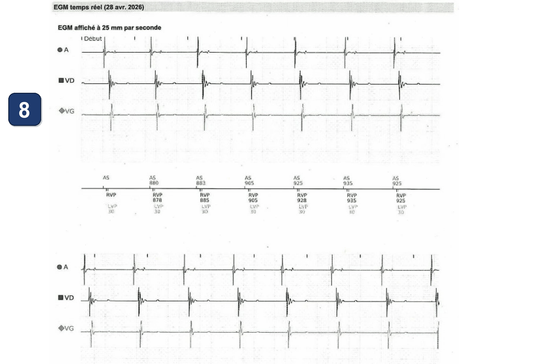 Électrogramme Boston Scientific CRT, segment 10/10 — LOT-CRT avec un CRT-P Boston