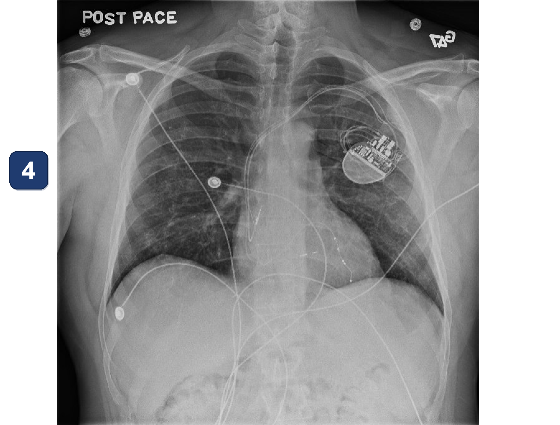 Électrogramme Boston Scientific CRT, segment 5/10 — LOT-CRT avec un CRT-P Boston