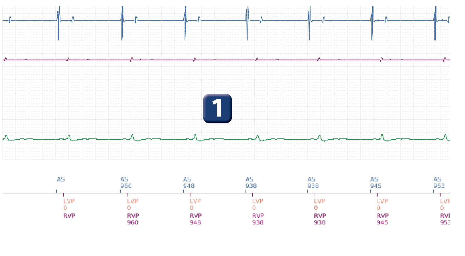 Électrogramme Boston Scientific DAI, segment 1 sur 6 — Détection et traitement d’un épisode de FV