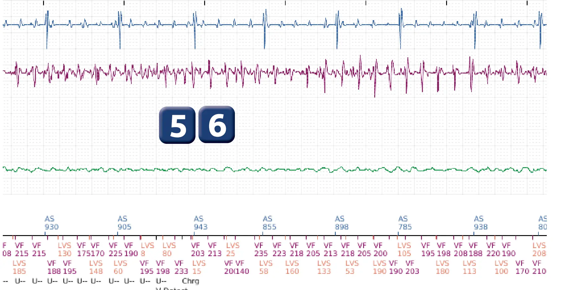 Électrogramme Boston Scientific DAI, segment 3 sur 6 — Détection et traitement d’un épisode de FV