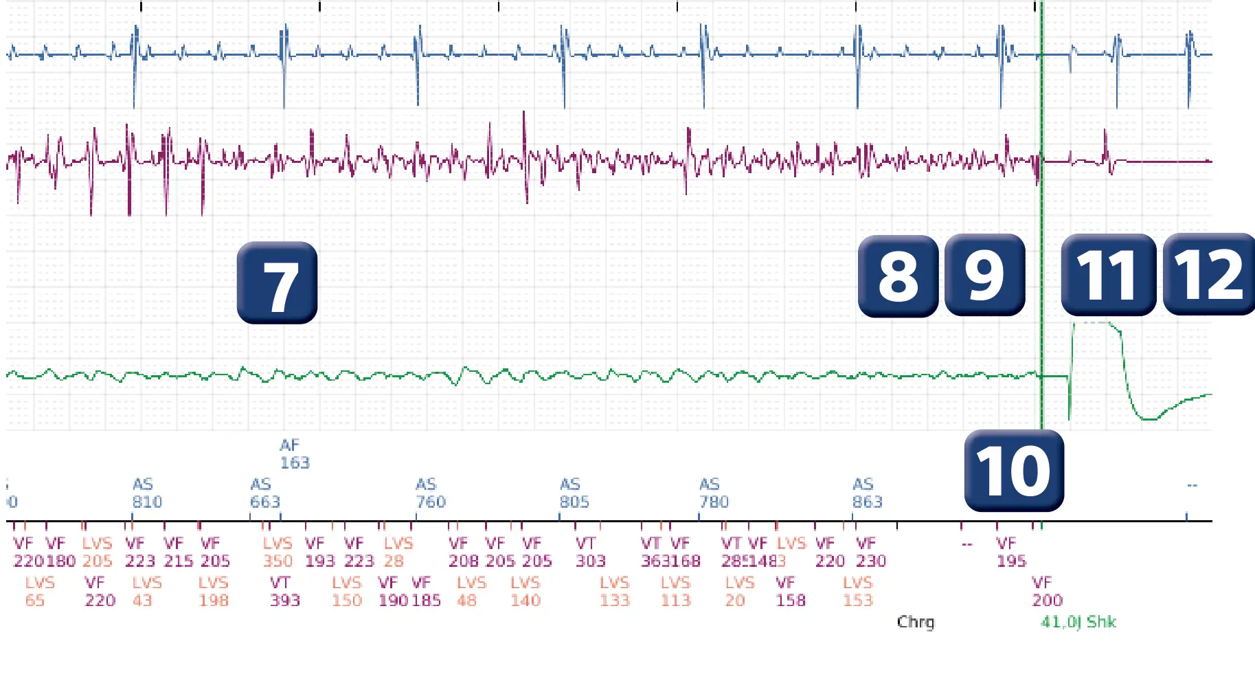 Électrogramme Boston Scientific DAI, segment 4 sur 6 — Détection et traitement d’un épisode de FV