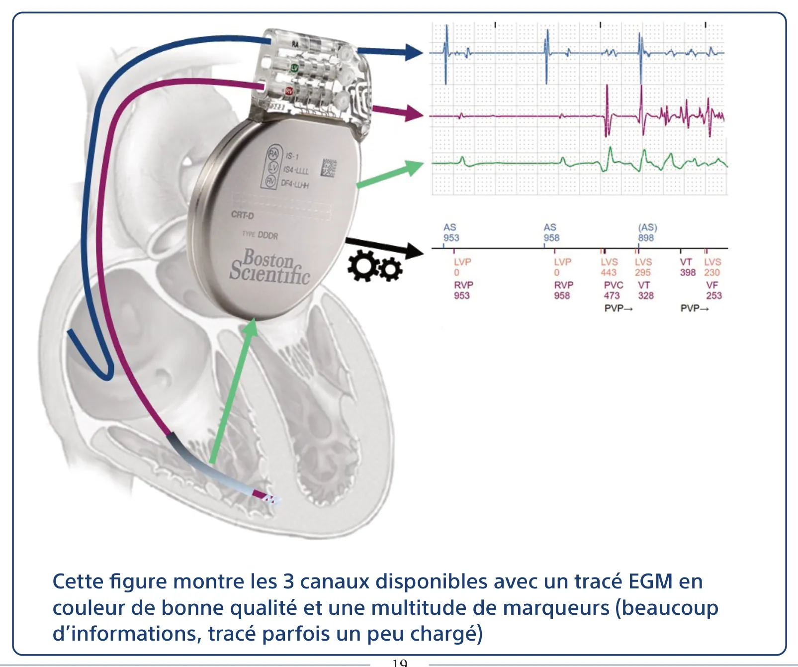 Cette figure montre les 3 canaux disponibles avec un tracé EGM en couleur de bonne qualité et une multitude de marqueurs (beaucoup d’informations, tracé parfois un peu chargé)