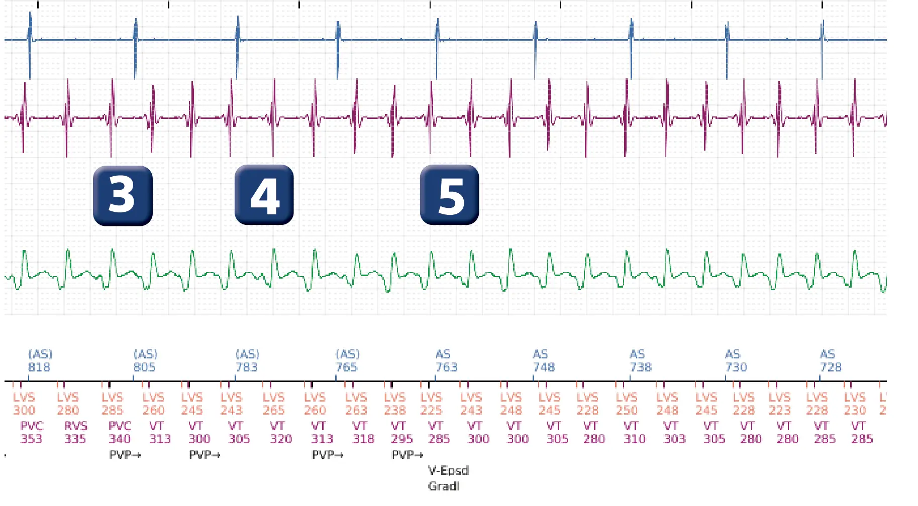 Électrogramme Boston Scientific DAI, segment 2 sur 4 — Tachycardie ventriculaire non soutenue