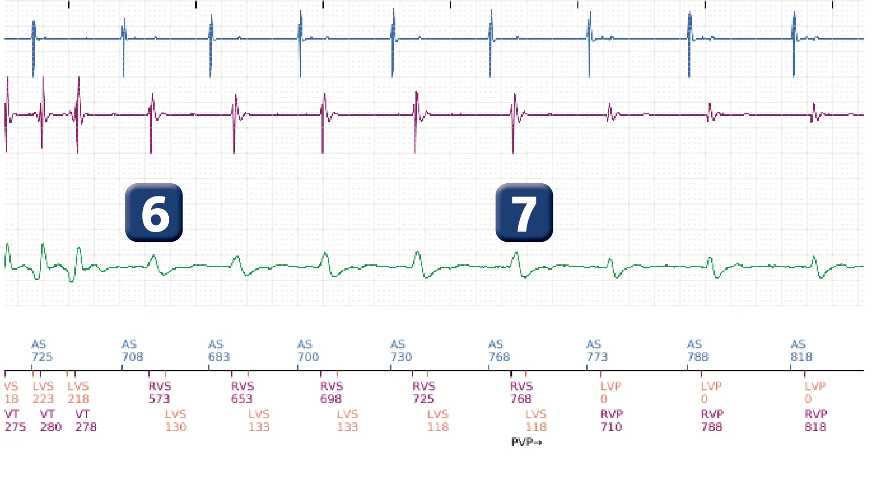 Électrogramme Boston Scientific DAI, segment 3 sur 4 — Tachycardie ventriculaire non soutenue