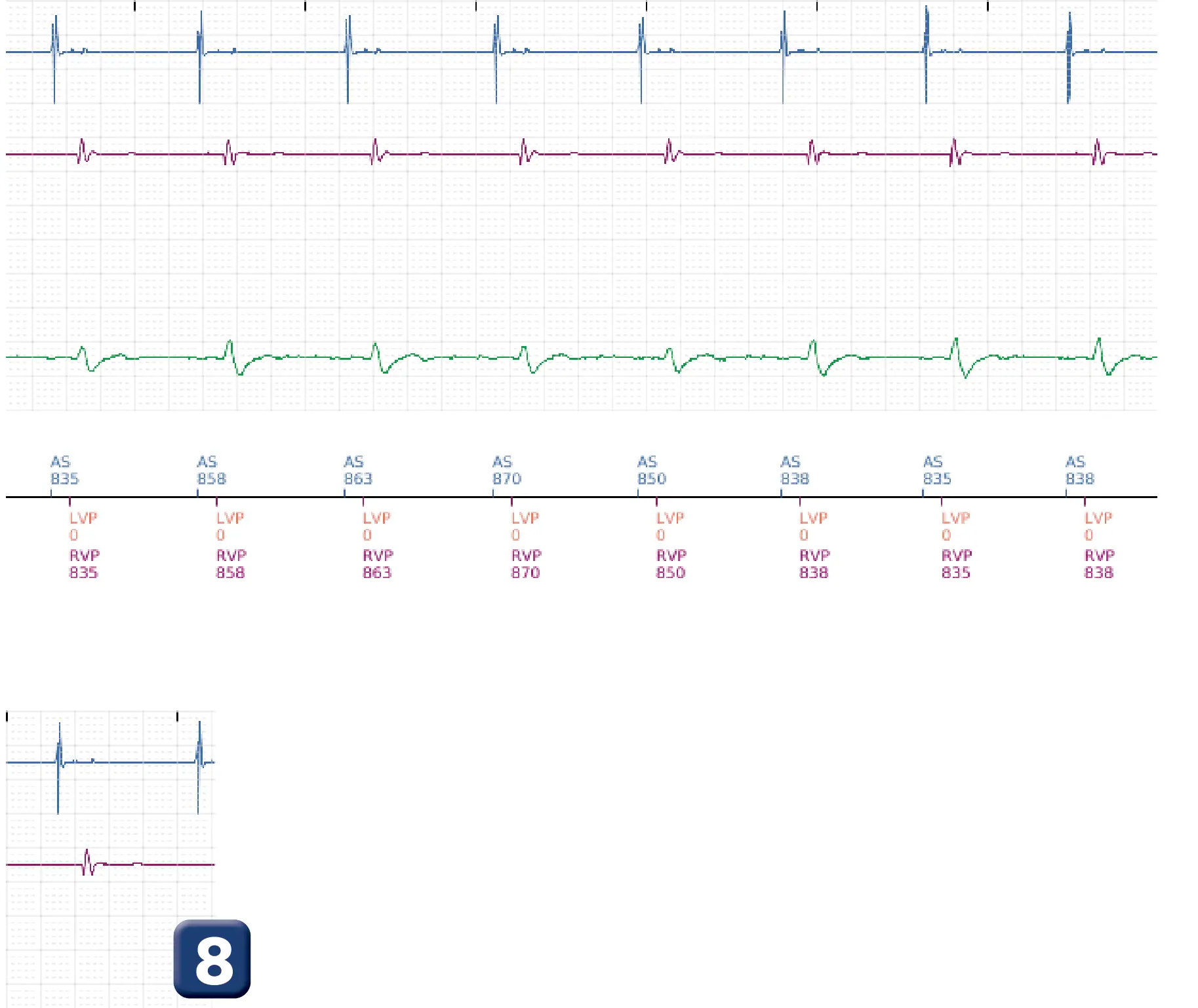 Électrogramme Boston Scientific DAI, segment 4 sur 4 — Tachycardie ventriculaire non soutenue