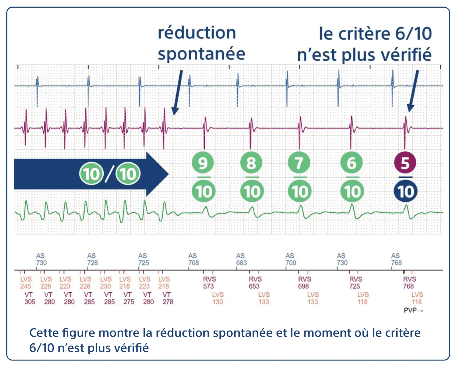 Extrait des recommandations HRS/EHRA de 2019 avec le QR code (PDF) Cette figure montre la réduction spontanée et le moment où le critère 6/10 n’est plus vérifié