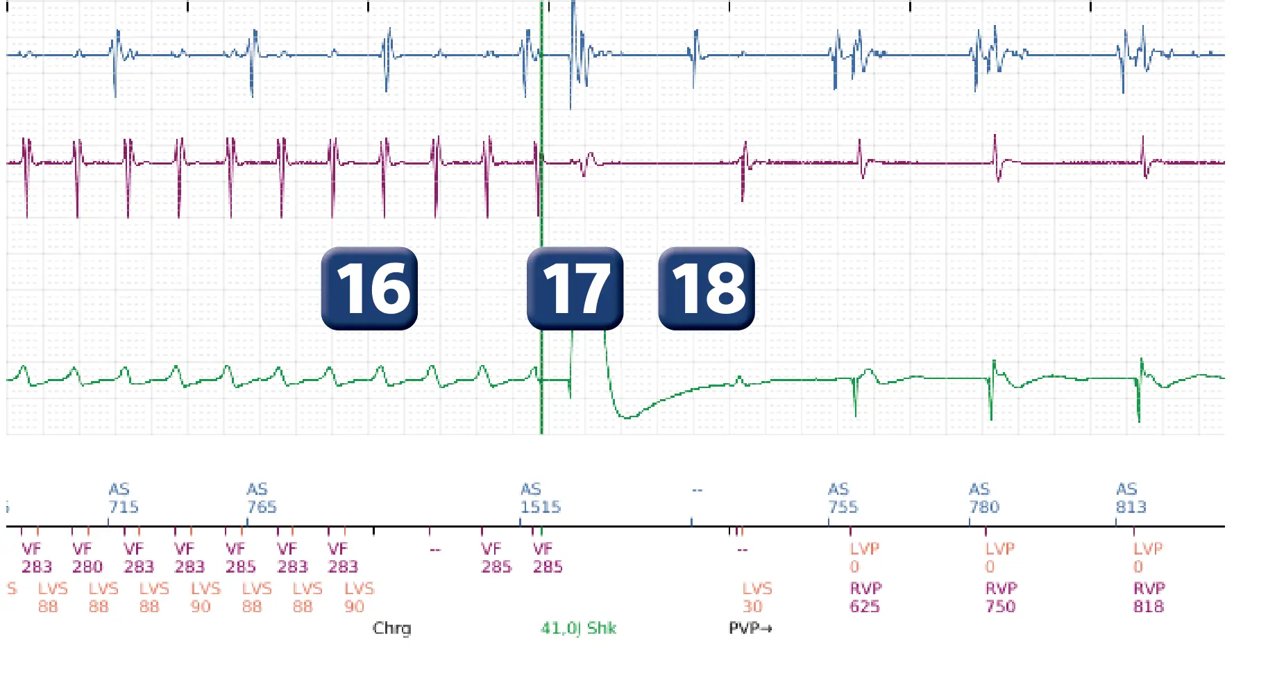 Électrogramme Boston Scientific DAI, segment 5 sur 6 — Changement de zone de détection