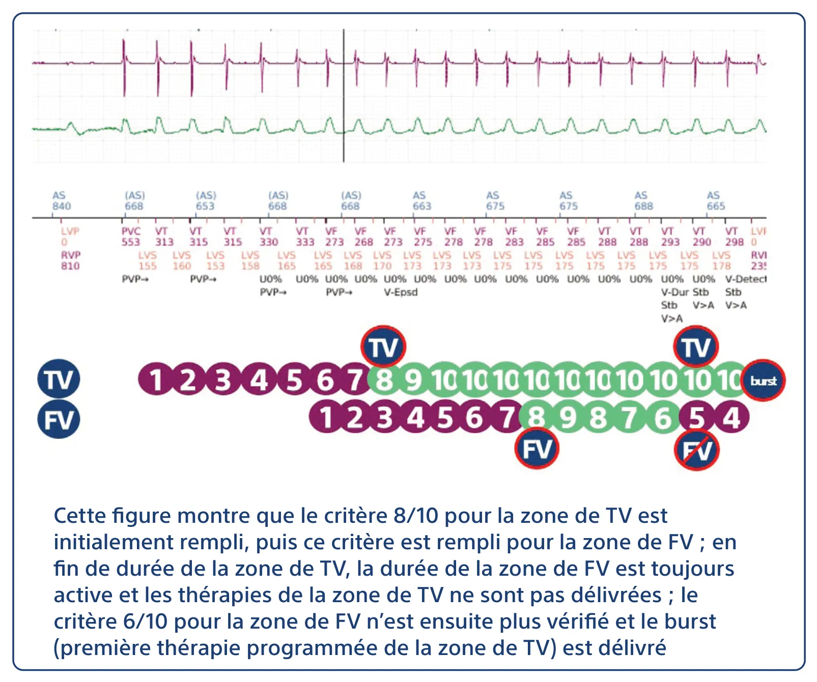 Cette figure montre que le critère 8/10 pour la zone de TV est initialement rempli, puis ce critère est rempli pour la zone de FV ; en fin de durée de la zone de TV, la durée de la zone de FV est toujours active et les thérapies de la zone de TV ne sont pas délivrées ; le critère 6/10 pour la zone de FV n’est ensuite plus vérifié et le burst (première thérapie programmée de la zone de TV) est délivré