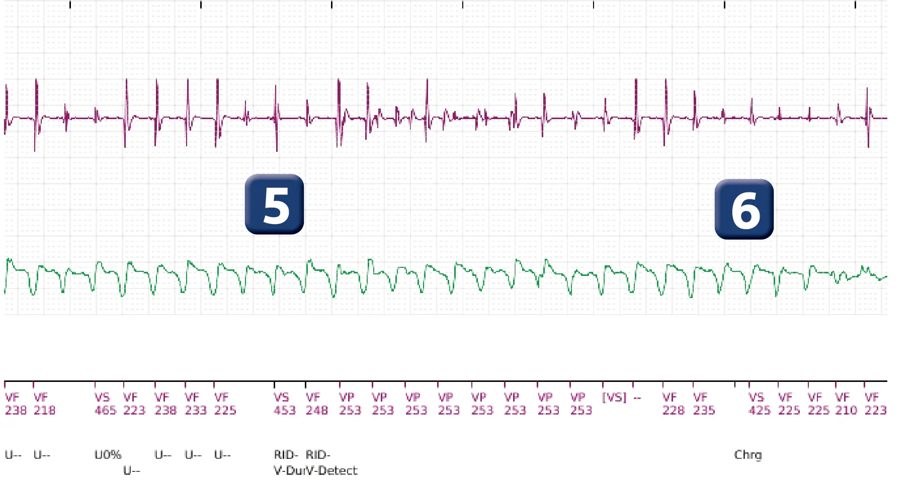 Électrogramme Boston Scientific DAI, segment 3 sur 5 — Réduction spontanée et déviation de la charge