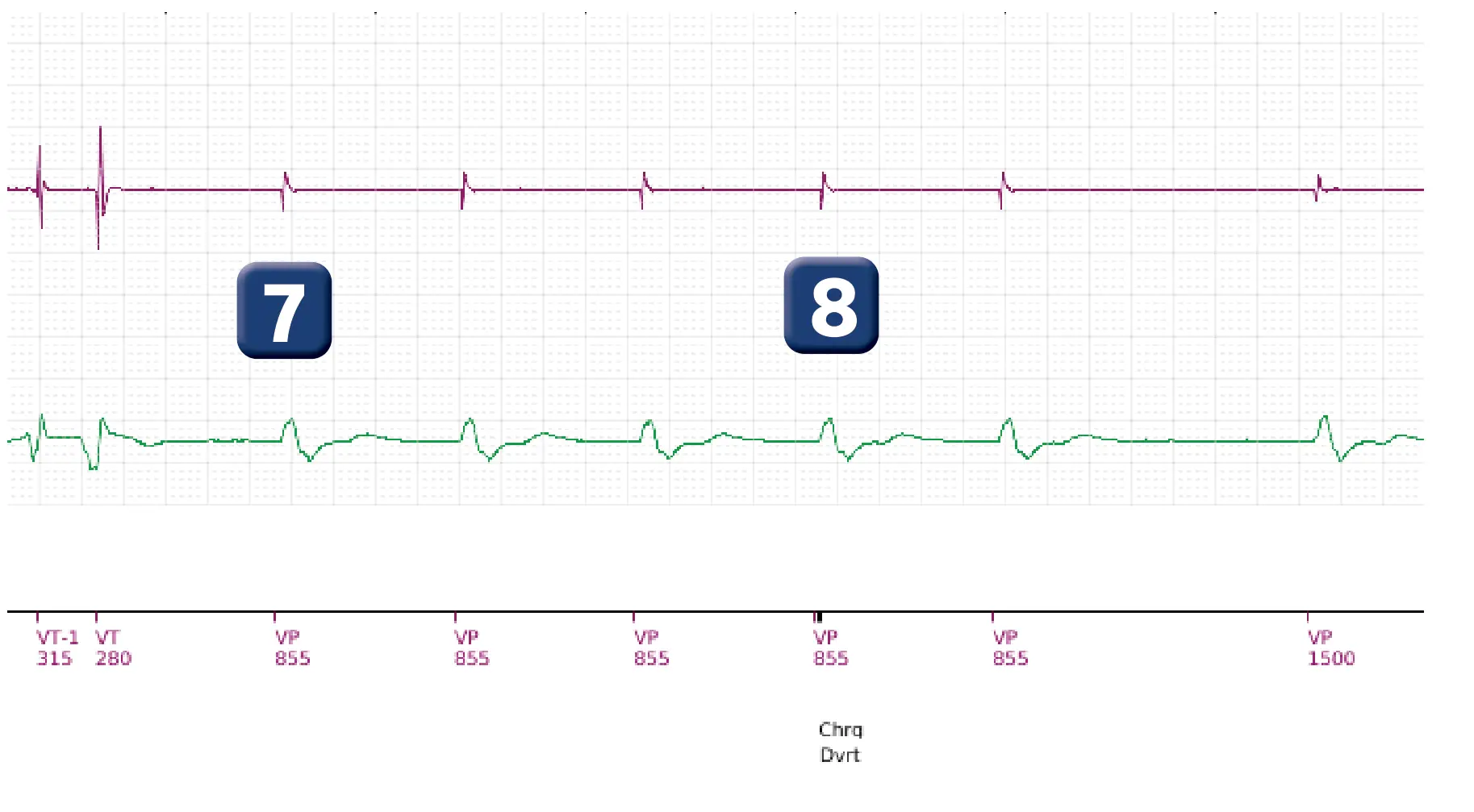 Électrogramme Boston Scientific DAI, segment 4 sur 5 — Réduction spontanée et déviation de la charge