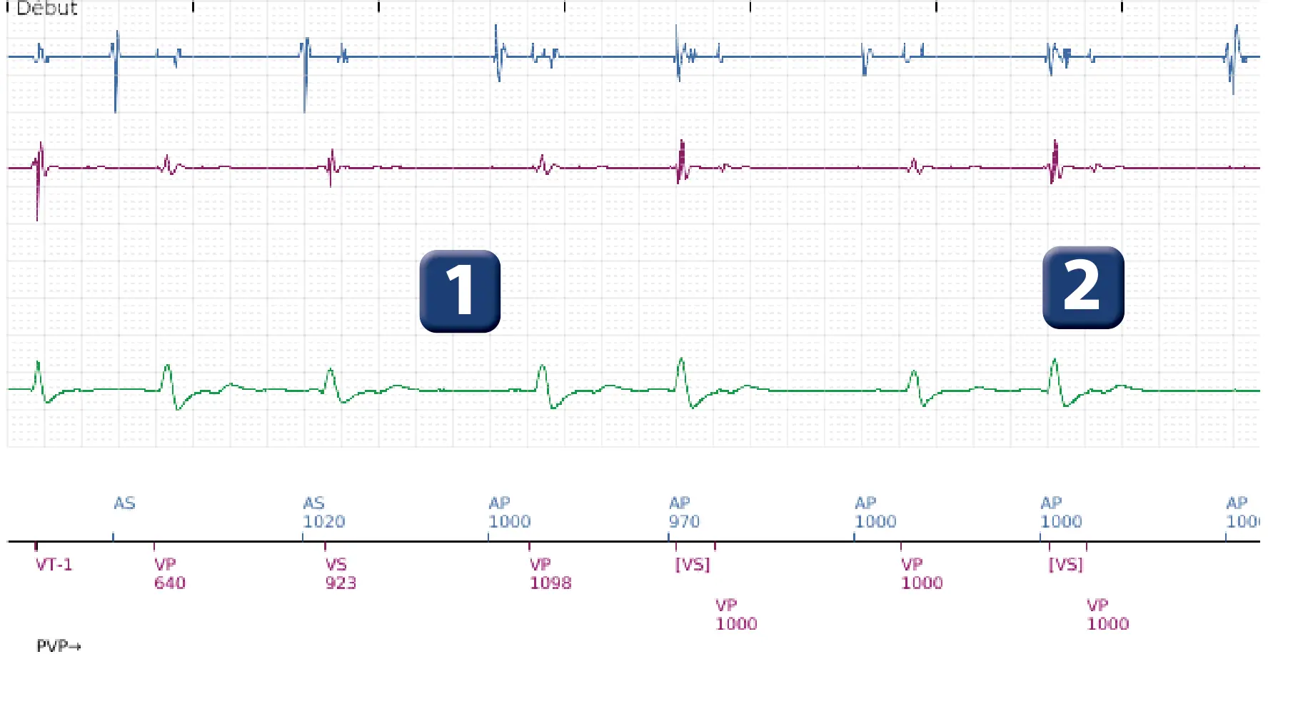 Électrogramme Boston Scientific DAI, segment 1 sur 5 — Réduction spontanée et déviation de la charge