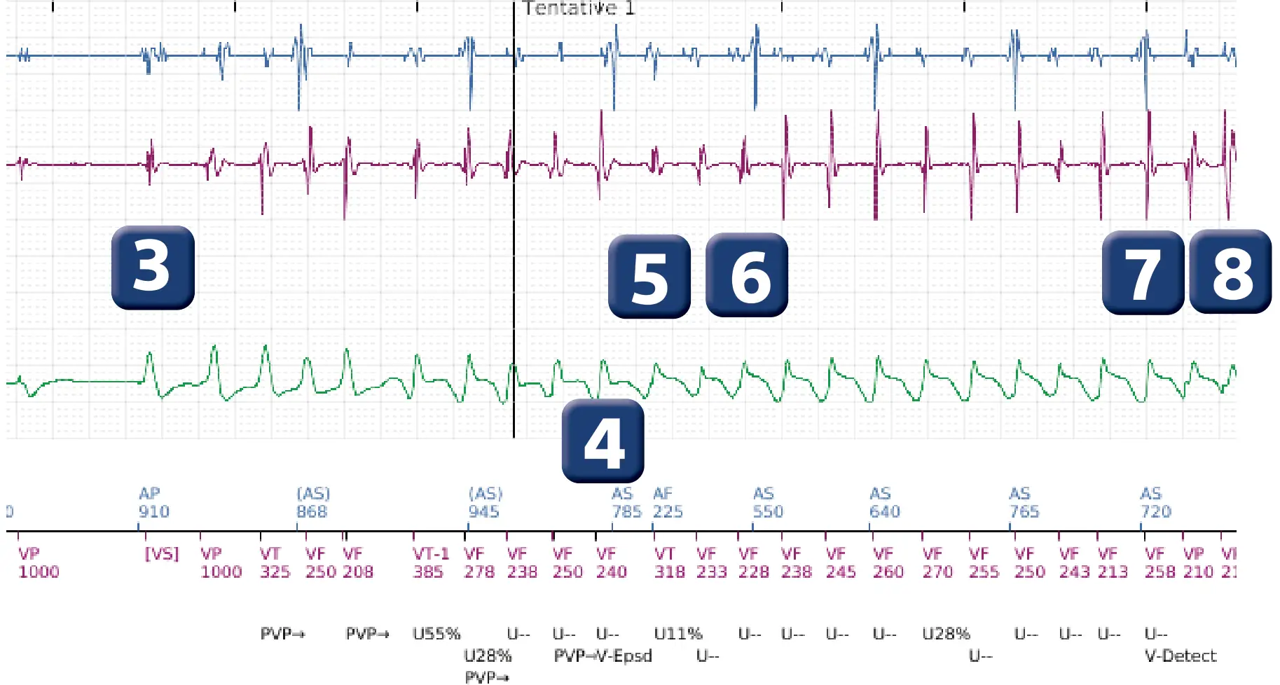 Électrogramme Boston Scientific DAI, segment 2 sur 5 — Réduction spontanée et déviation de la charge