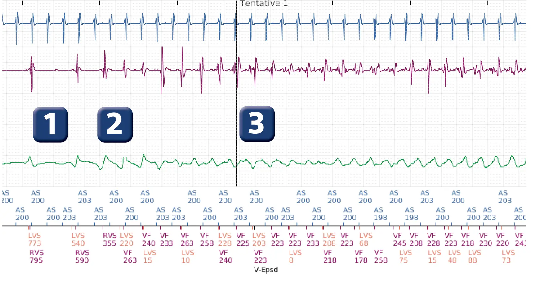 Électrogramme Boston Scientific DAI, segment 1 sur 4 — Fenêtre de déviation en fin de charge
