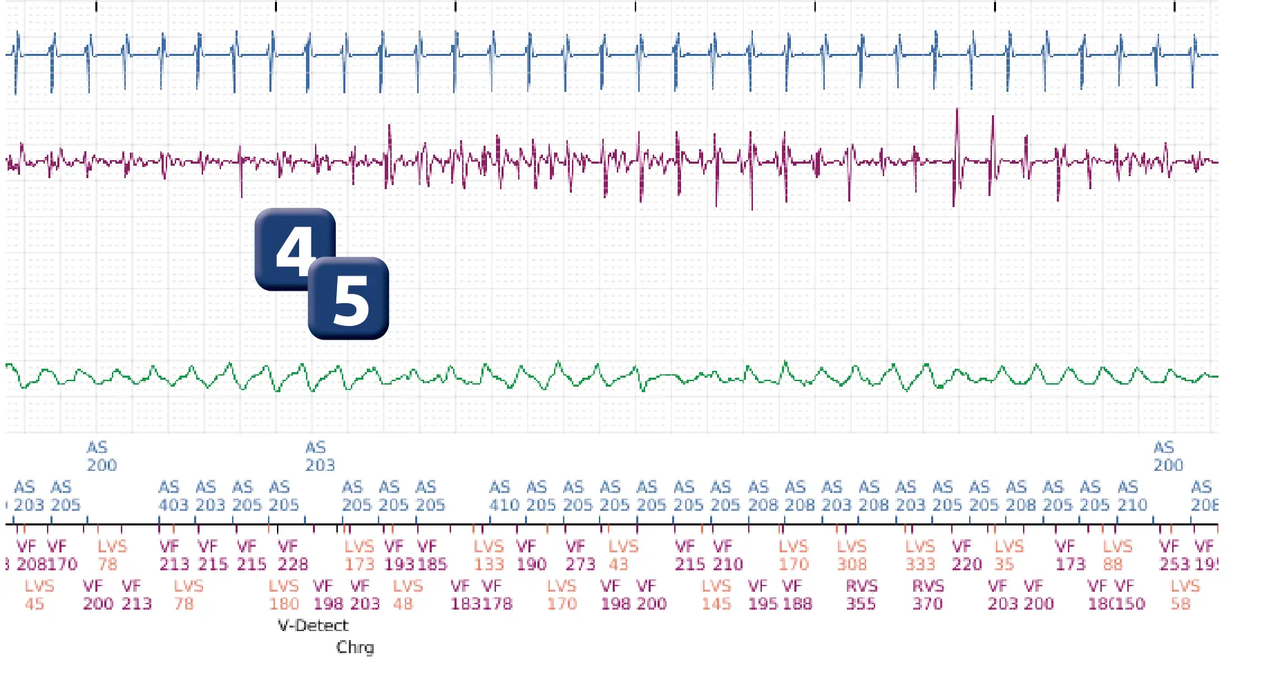 Électrogramme Boston Scientific DAI, segment 2 sur 4 — Fenêtre de déviation en fin de charge