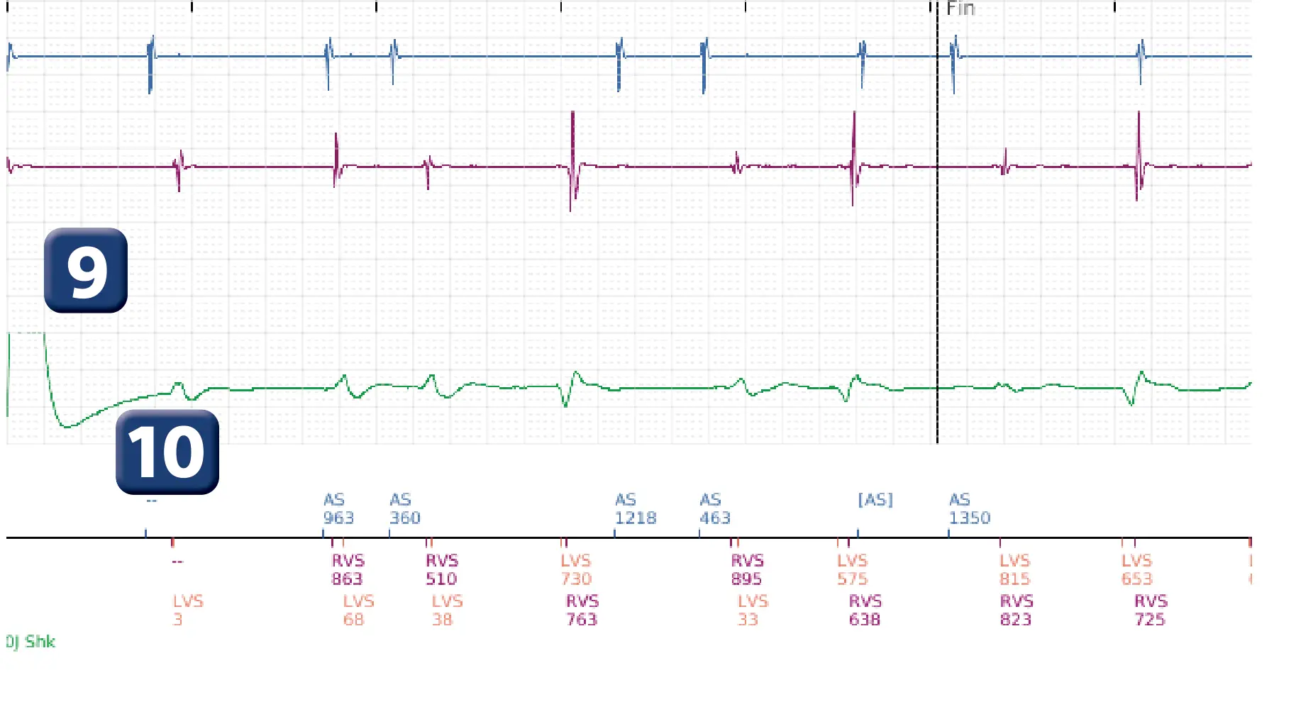Électrogramme Boston Scientific DAI, segment 4 sur 4 — Fenêtre de déviation en fin de charge