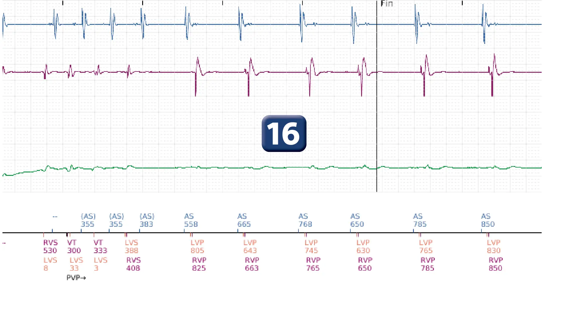 Électrogramme Boston Scientific DAI, segment 12 sur 19 — Critère de fin d’épisode à la suite d’un choc électrique
