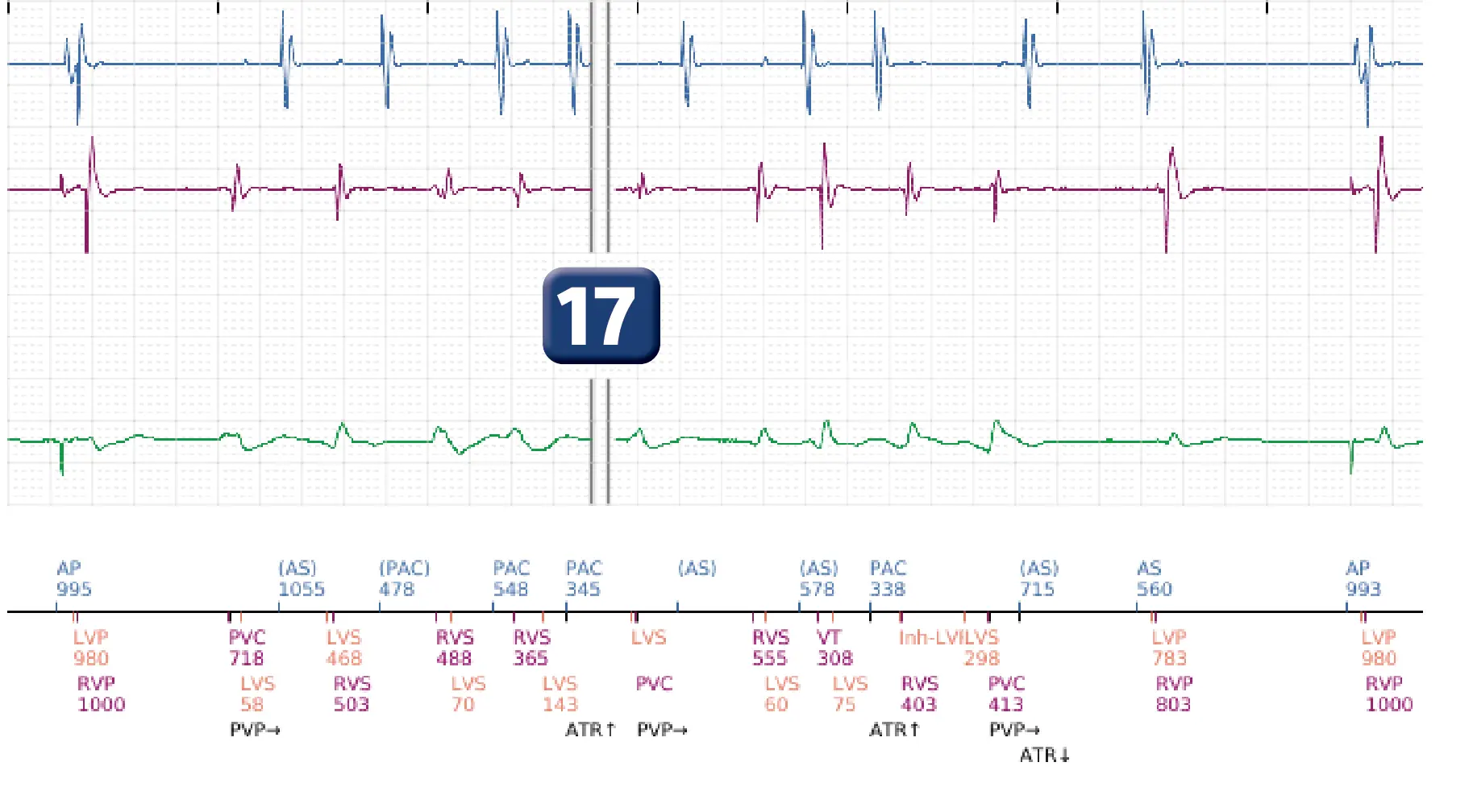 Électrogramme Boston Scientific DAI, segment 13 sur 19 — Critère de fin d’épisode à la suite d’un choc électrique