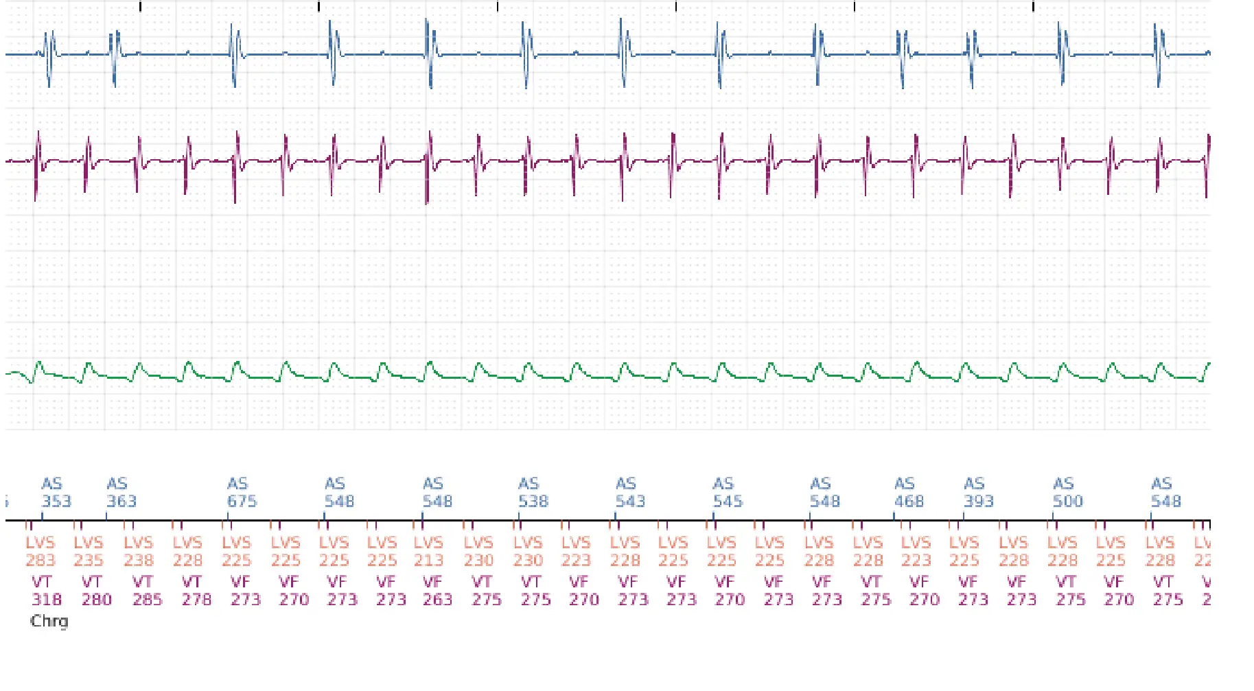 Électrogramme Boston Scientific DAI, segment 16 sur 19 — Critère de fin d’épisode à la suite d’un choc électrique