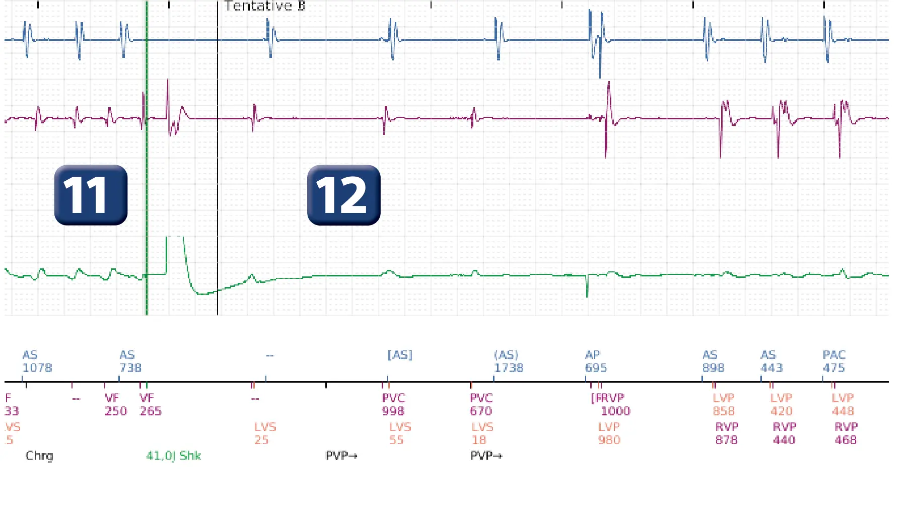 Électrogramme Boston Scientific DAI, segment 6 sur 19 — Critère de fin d’épisode à la suite d’un choc électrique