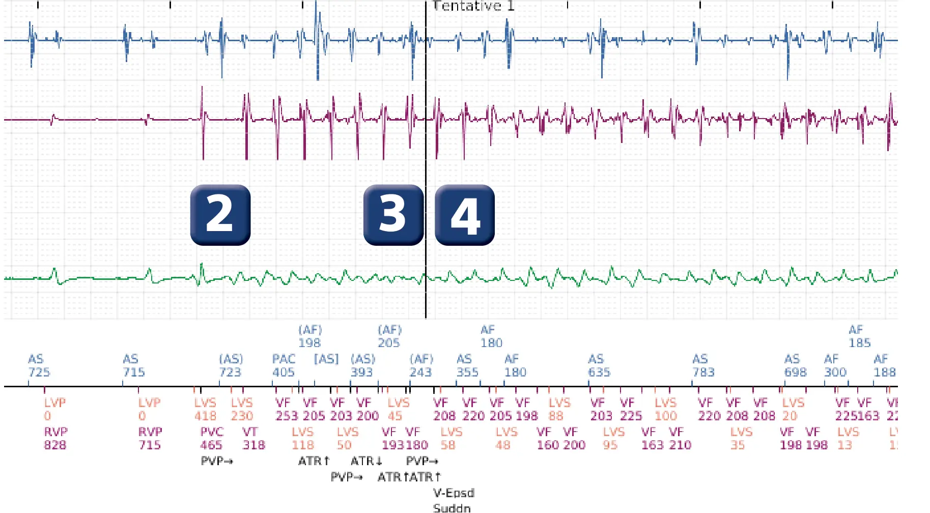 Électrogramme Boston Scientific DAI, segment 2 sur 5 — Episode de FV correctement détecté et traité par un choc d’énergie maximale