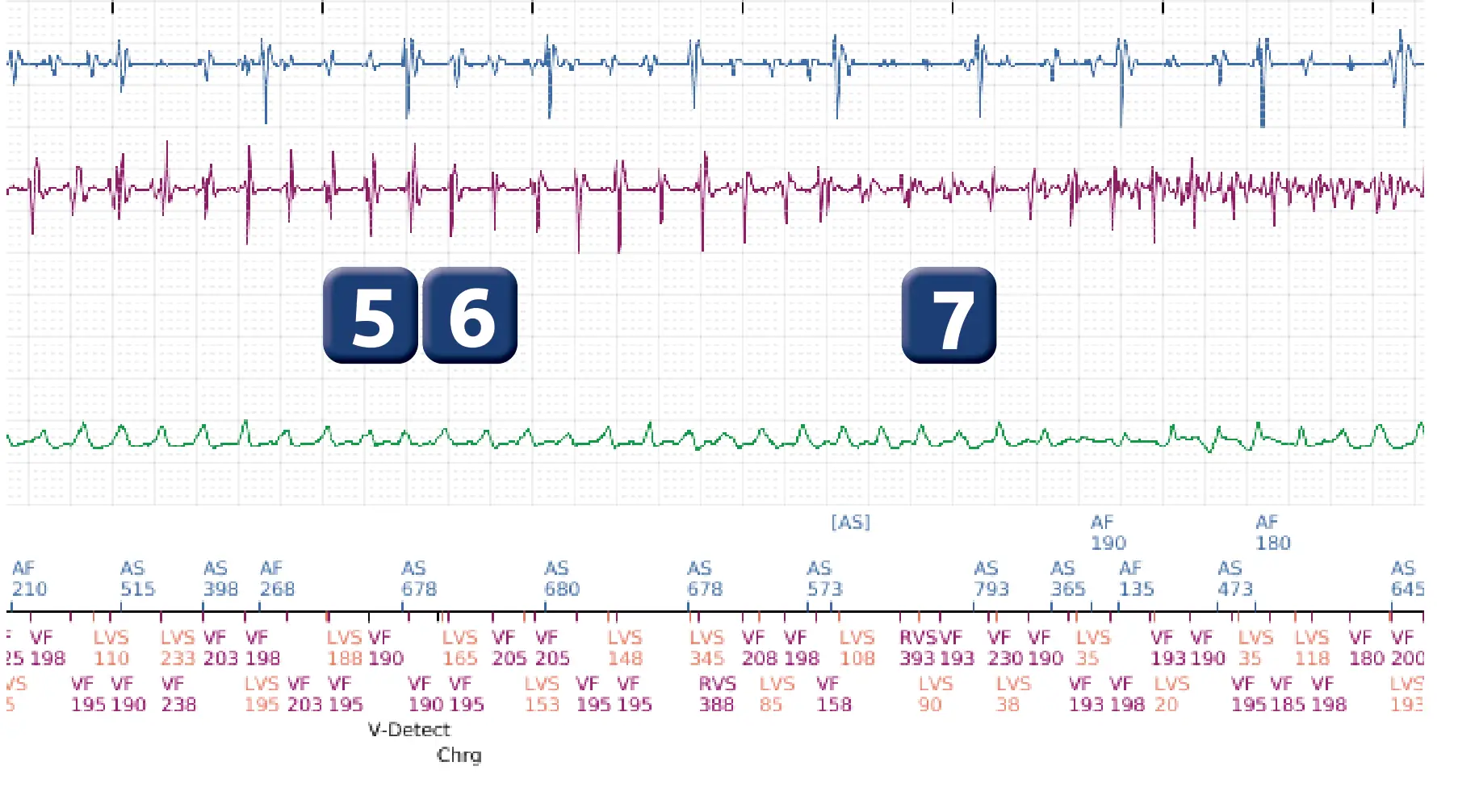 Électrogramme Boston Scientific DAI, segment 3 sur 5 — Episode de FV correctement détecté et traité par un choc d’énergie maximale