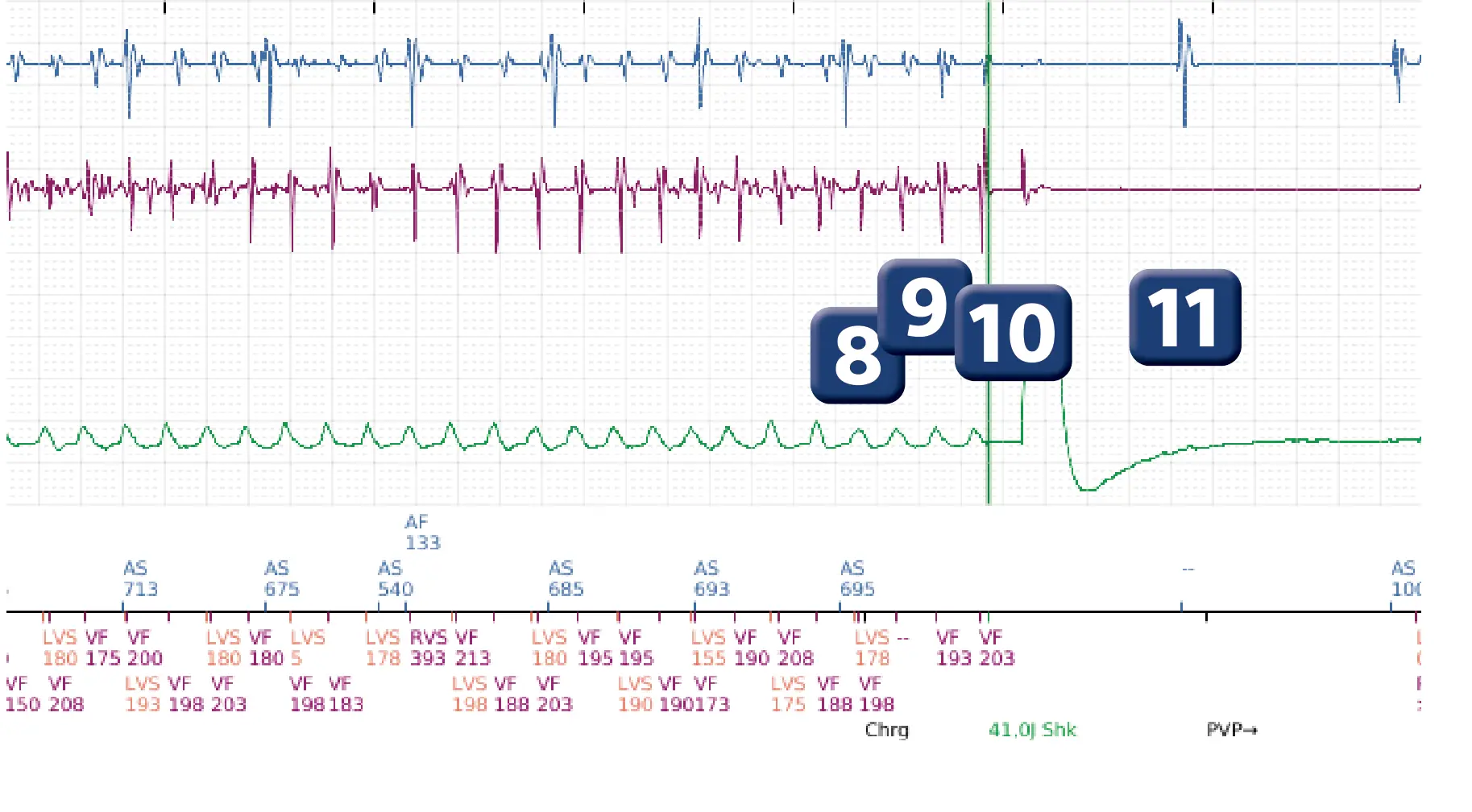 Électrogramme Boston Scientific DAI, segment 4 sur 5 — Episode de FV correctement détecté et traité par un choc d’énergie maximale