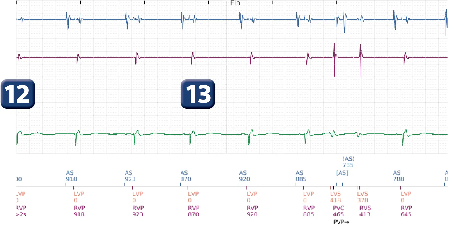Électrogramme Boston Scientific DAI, segment 5 sur 5 — Episode de FV correctement détecté et traité par un choc d’énergie maximale