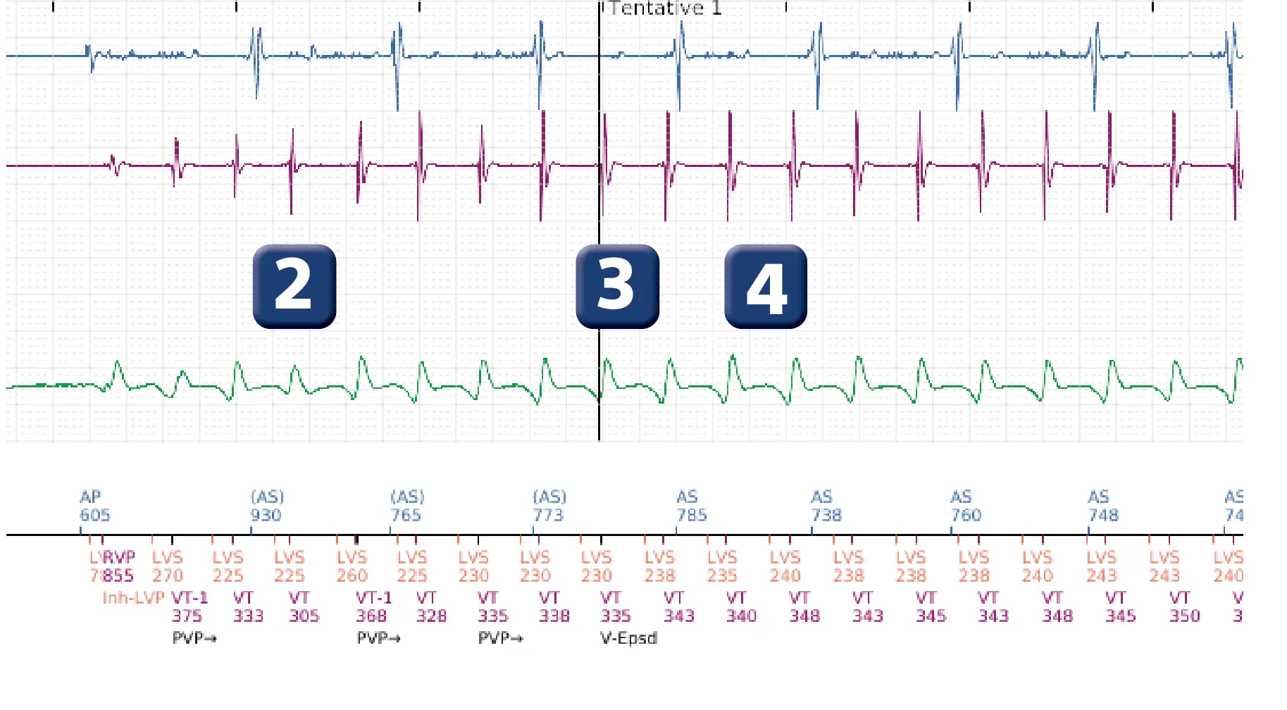 Électrogramme Boston Scientific DAI, segment 2 sur 5 — Stimulation anti-tachycardique en zone de TV