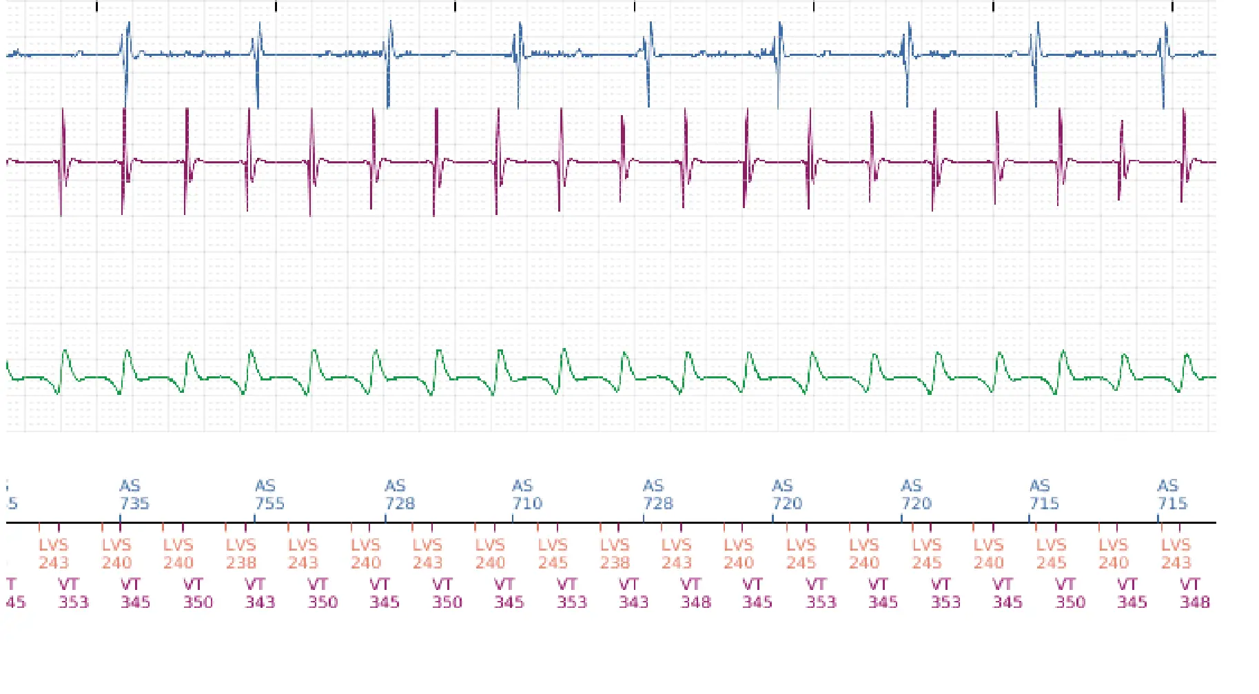 Électrogramme Boston Scientific DAI, segment 3 sur 5 — Stimulation anti-tachycardique en zone de TV