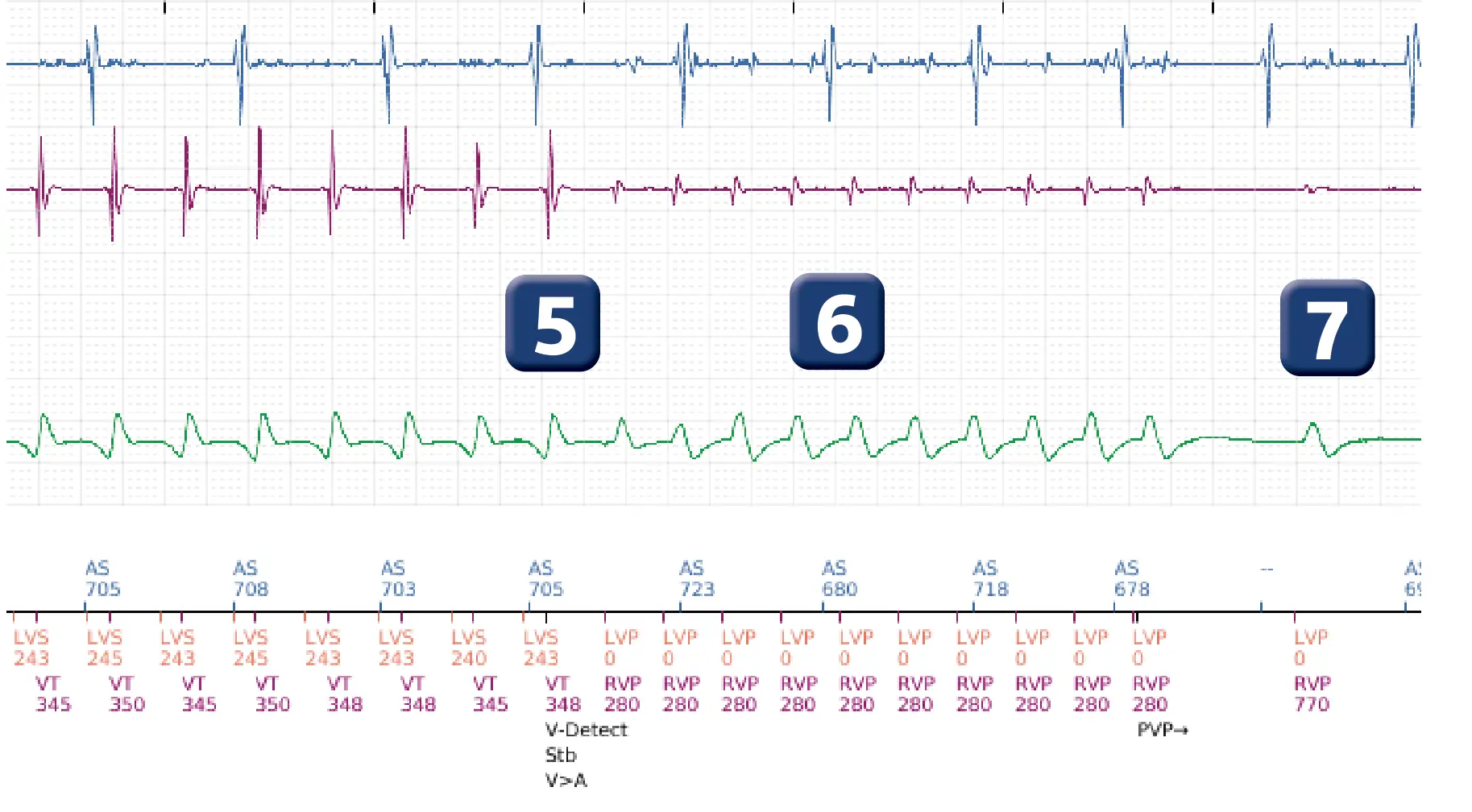 Électrogramme Boston Scientific DAI, segment 4 sur 5 — Stimulation anti-tachycardique en zone de TV