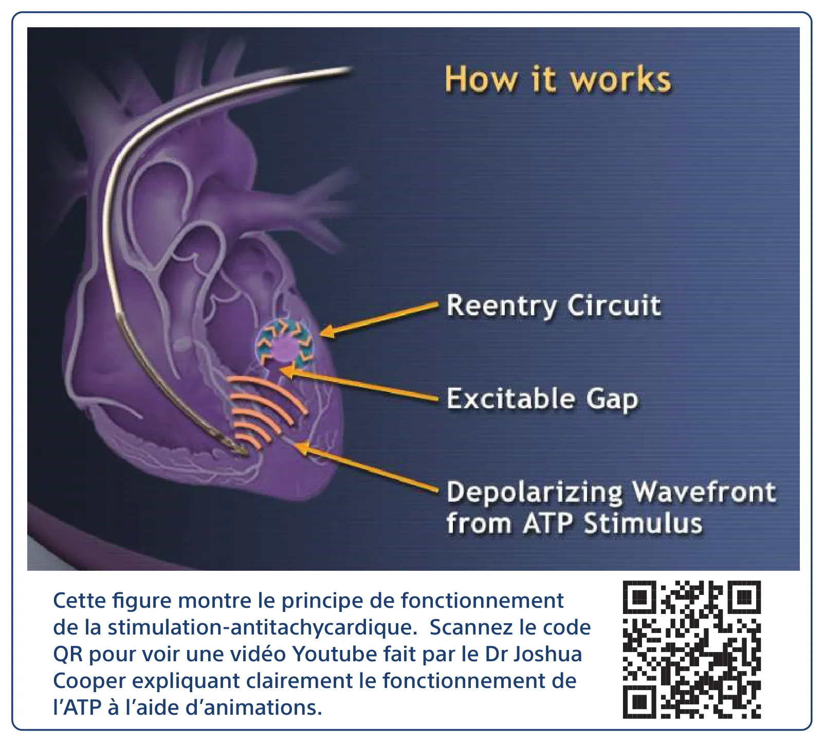 Cette figure montre le principe de fonctionnement de la stimulation-antitachycardique. Scannez le code QR pour voir une vidéo Youtube fait par le Dr Joshua Cooper expliquant clairement le fonctionnement de l’ATP à l’aide d’animations.