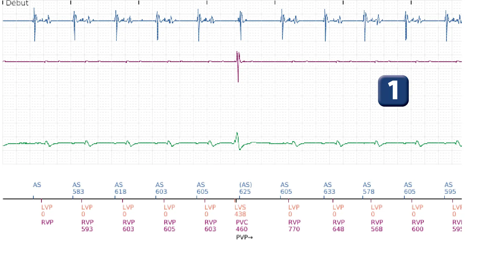 Électrogramme Boston Scientific DAI, segment 1 sur 16 — Stimulation anti-tachycardique en zone de TV et durée post-redétection