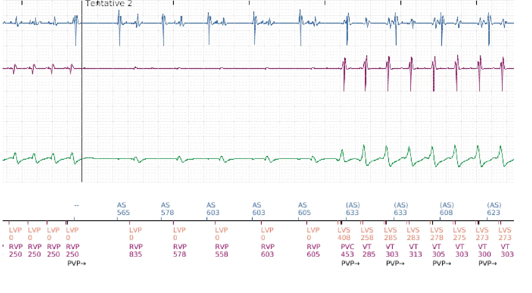 Électrogramme Boston Scientific DAI, segment 10 sur 16 — Stimulation anti-tachycardique en zone de TV et durée post-redétection