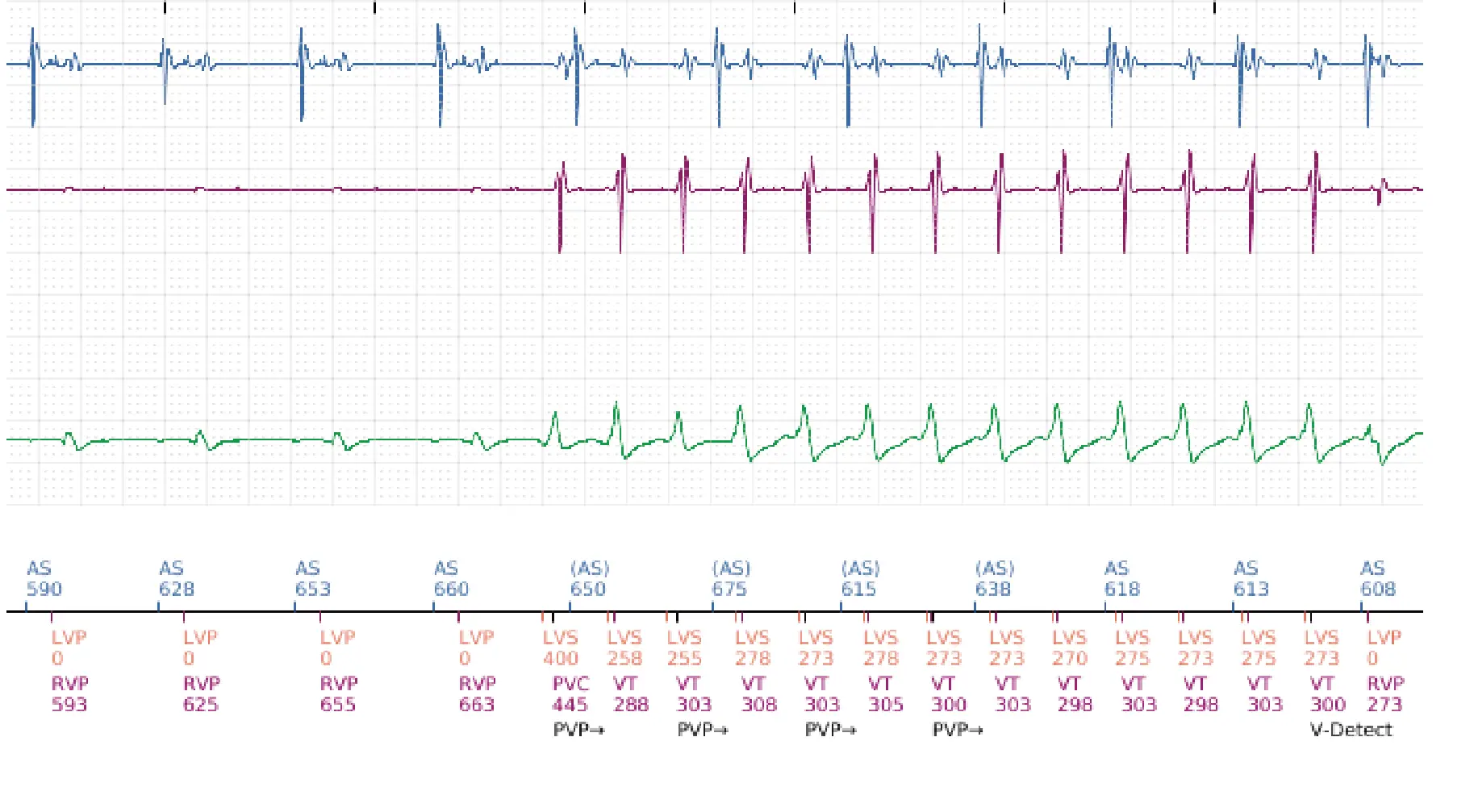 Électrogramme Boston Scientific DAI, segment 12 sur 16 — Stimulation anti-tachycardique en zone de TV et durée post-redétection