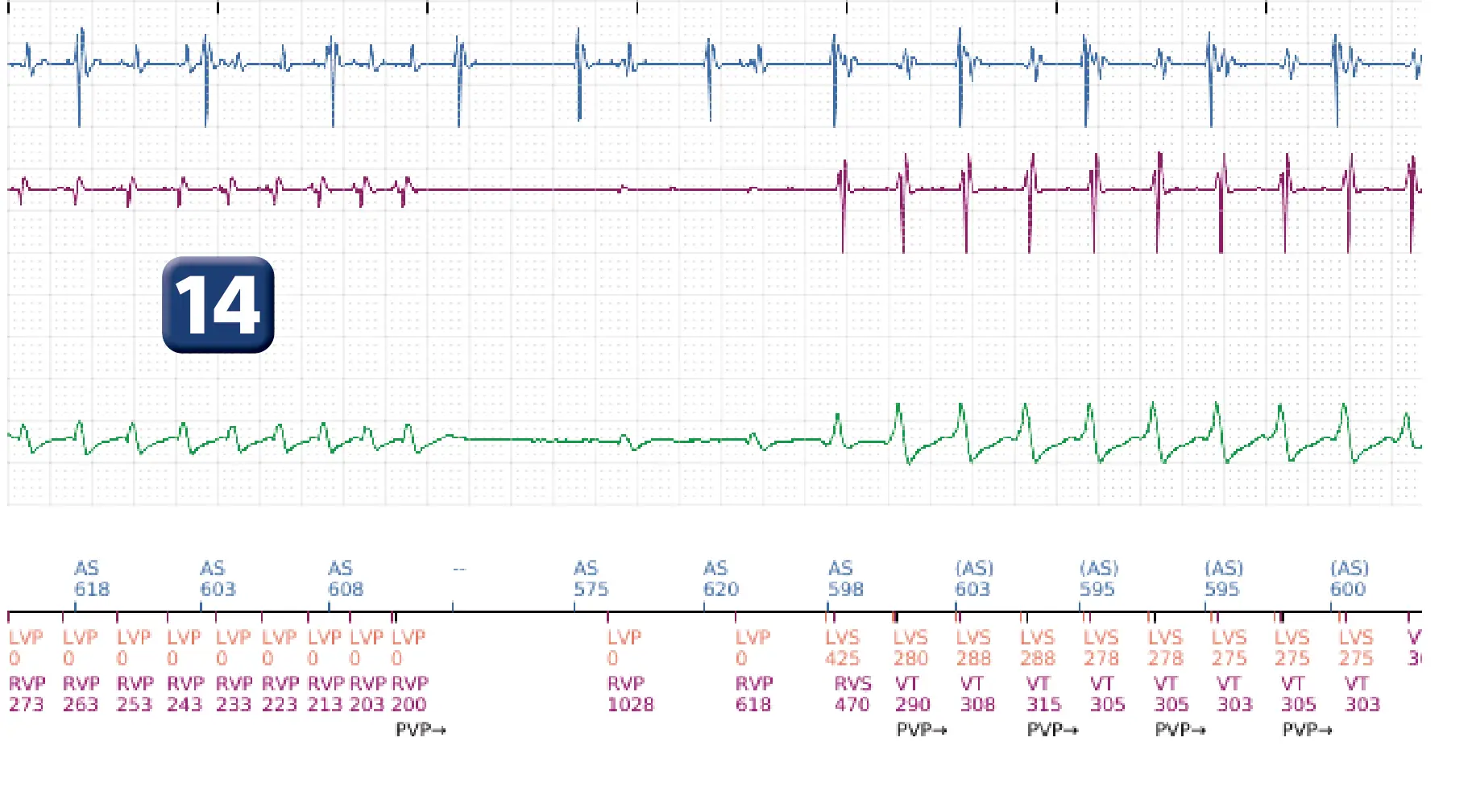Électrogramme Boston Scientific DAI, segment 13 sur 16 — Stimulation anti-tachycardique en zone de TV et durée post-redétection