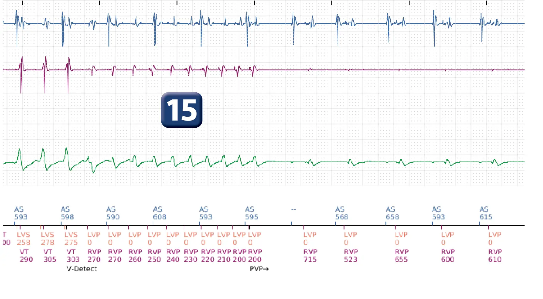 Électrogramme Boston Scientific DAI, segment 14 sur 16 — Stimulation anti-tachycardique en zone de TV et durée post-redétection