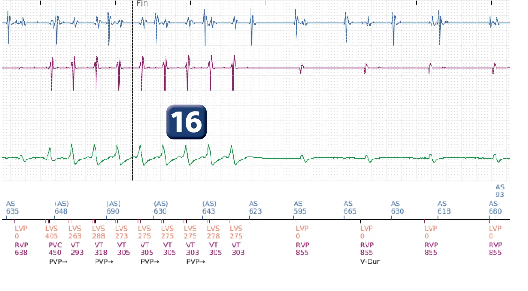 Électrogramme Boston Scientific DAI, segment 15 sur 16 — Stimulation anti-tachycardique en zone de TV et durée post-redétection