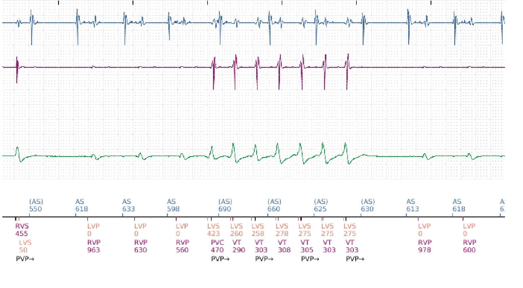 Électrogramme Boston Scientific DAI, segment 16 sur 16 — Stimulation anti-tachycardique en zone de TV et durée post-redétection