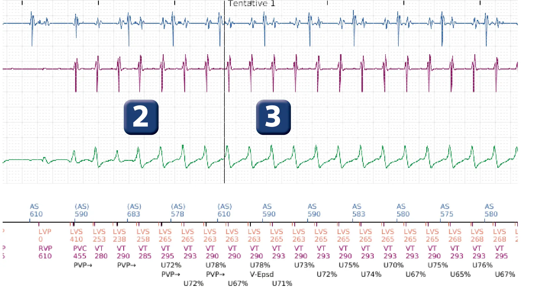 Électrogramme Boston Scientific DAI, segment 2 sur 16 — Stimulation anti-tachycardique en zone de TV et durée post-redétection