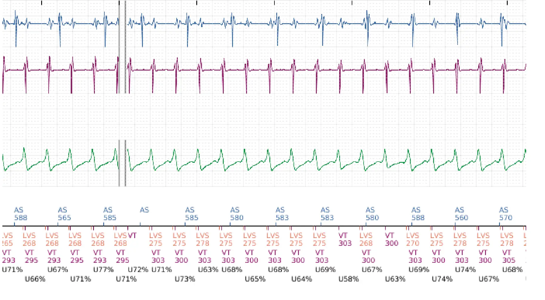 Électrogramme Boston Scientific DAI, segment 3 sur 16 — Stimulation anti-tachycardique en zone de TV et durée post-redétection