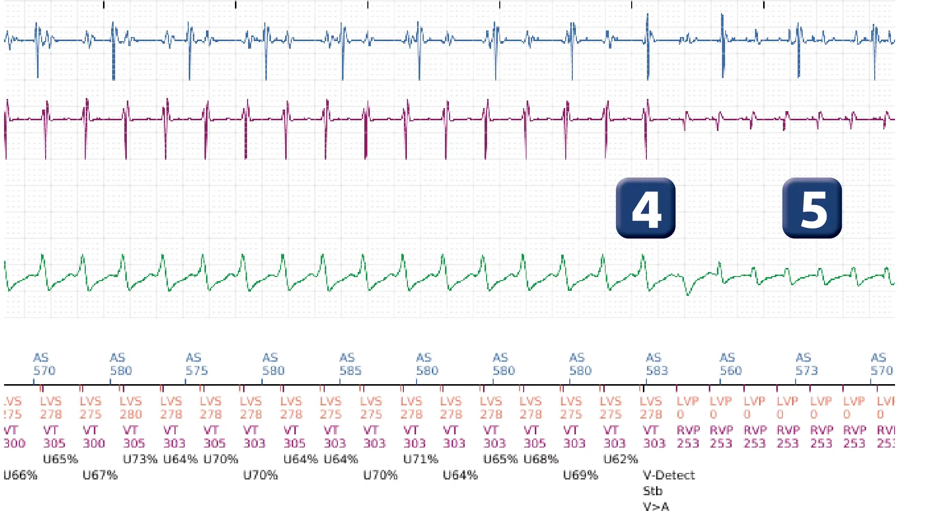 Électrogramme Boston Scientific DAI, segment 4 sur 16 — Stimulation anti-tachycardique en zone de TV et durée post-redétection