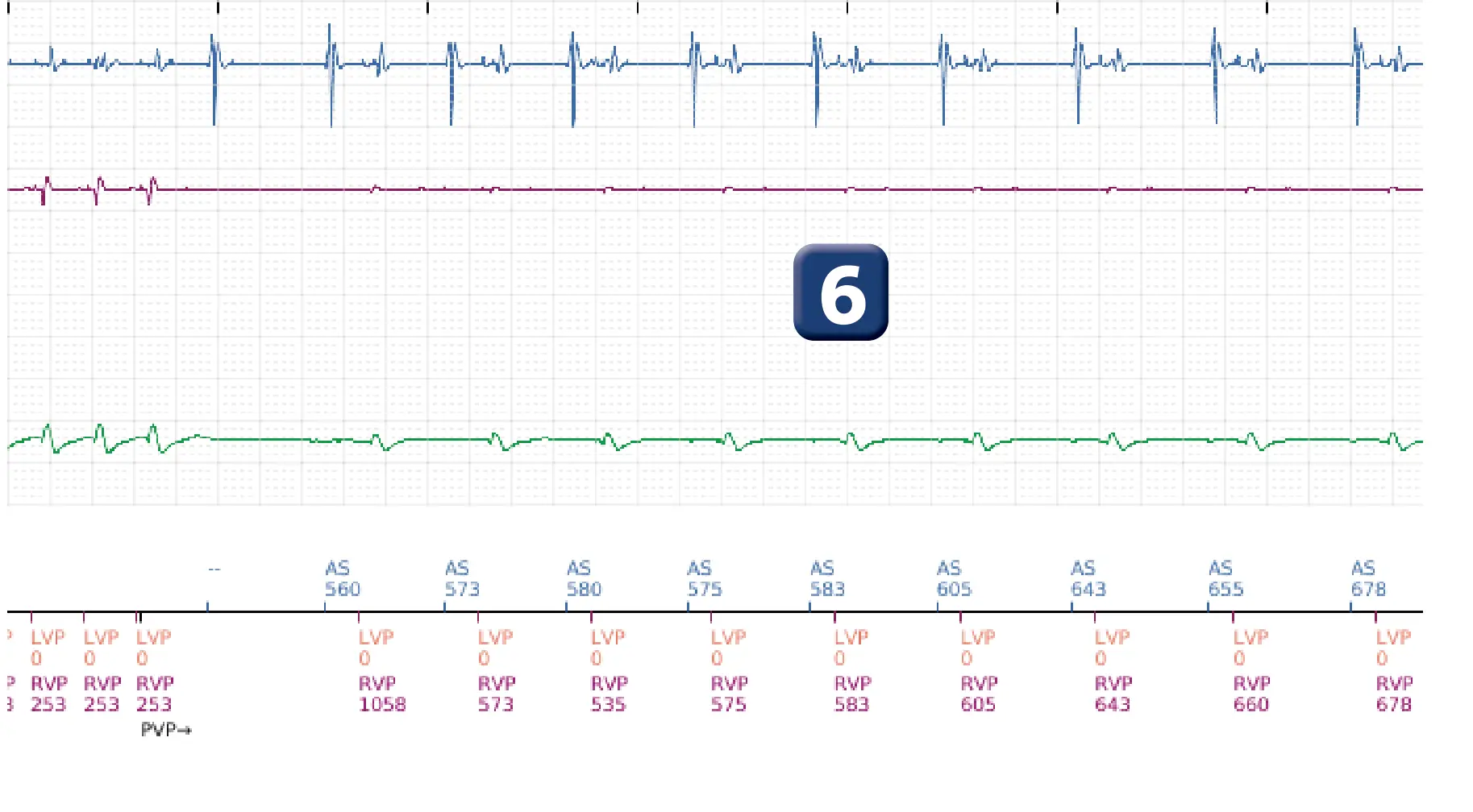Électrogramme Boston Scientific DAI, segment 5 sur 16 — Stimulation anti-tachycardique en zone de TV et durée post-redétection