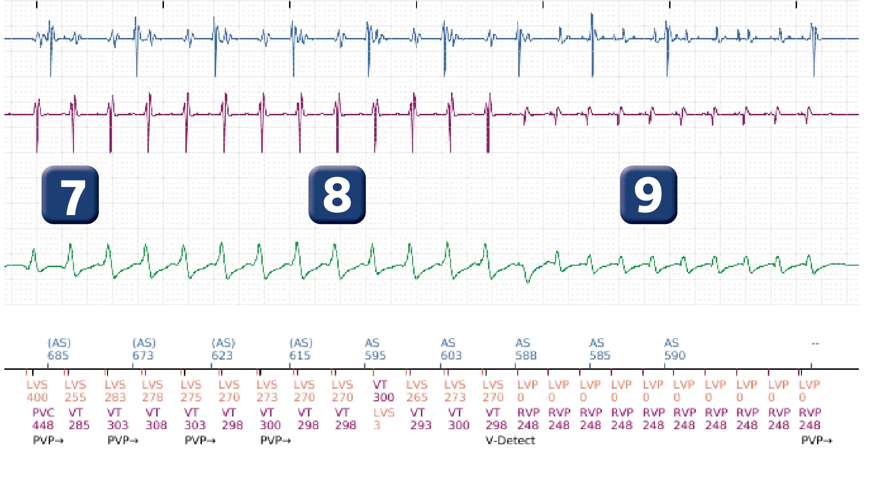 Électrogramme Boston Scientific DAI, segment 6 sur 16 — Stimulation anti-tachycardique en zone de TV et durée post-redétection
