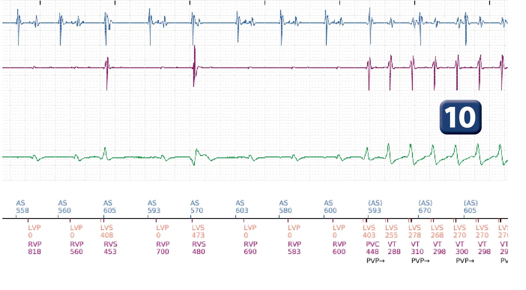 Électrogramme Boston Scientific DAI, segment 7 sur 16 — Stimulation anti-tachycardique en zone de TV et durée post-redétection