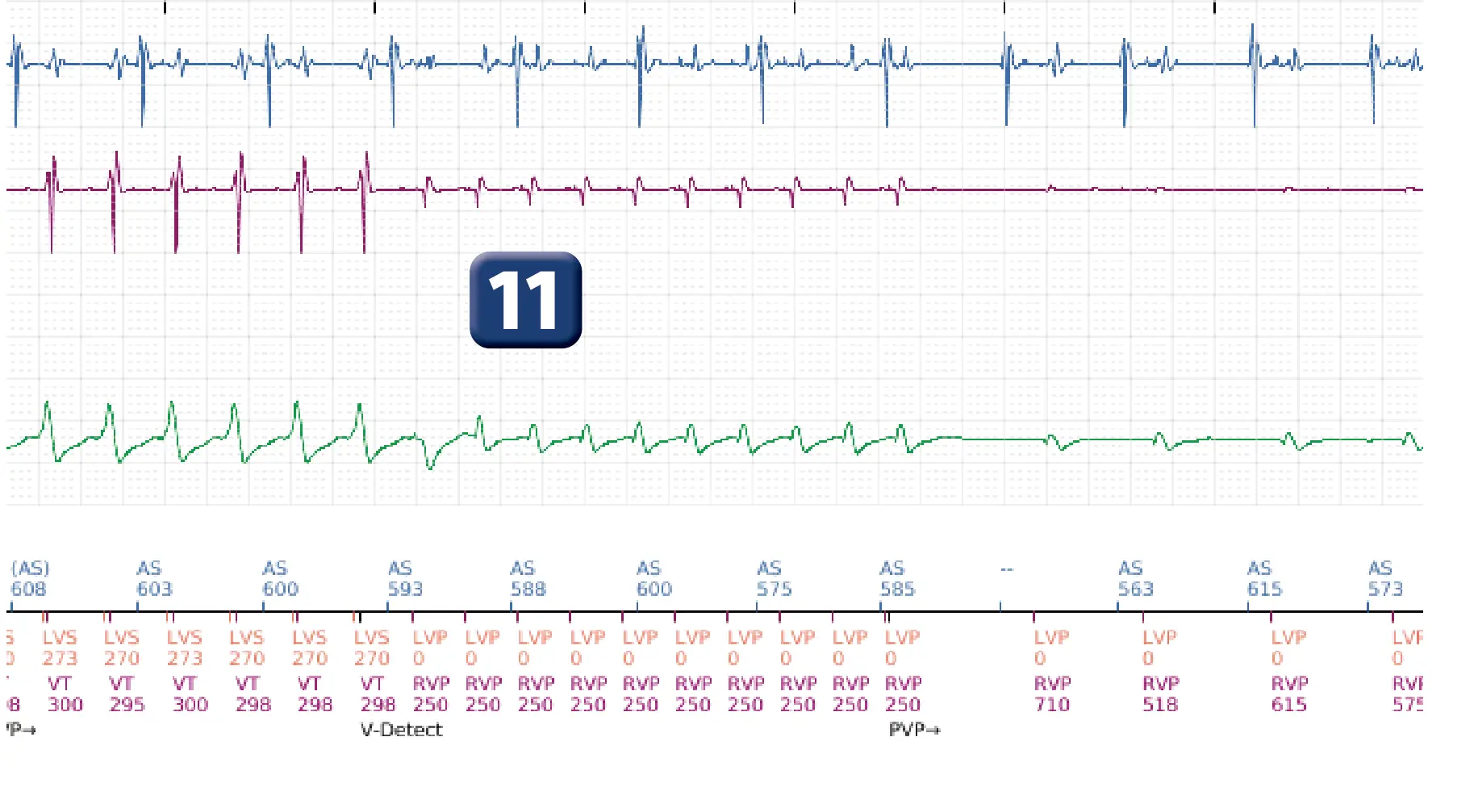 Électrogramme Boston Scientific DAI, segment 8 sur 16 — Stimulation anti-tachycardique en zone de TV et durée post-redétection