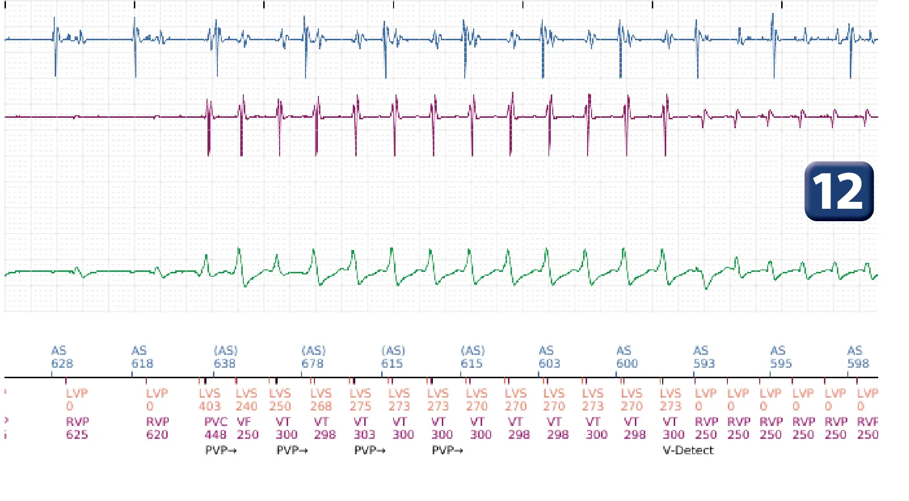 Électrogramme Boston Scientific DAI, segment 9 sur 16 — Stimulation anti-tachycardique en zone de TV et durée post-redétection