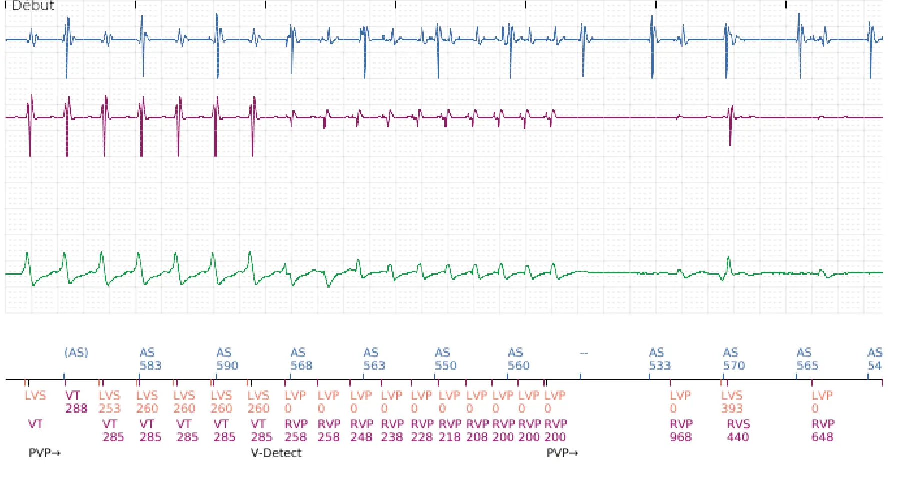 Électrogramme Boston Scientific DAI, segment 1 sur 16 — Progression des thérapies en zone de TV